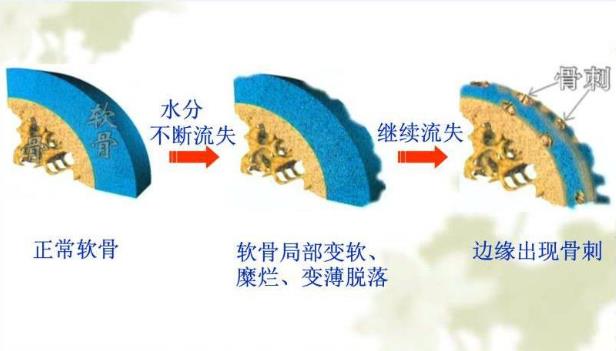 膝关节骨性关节炎的阶梯治疗