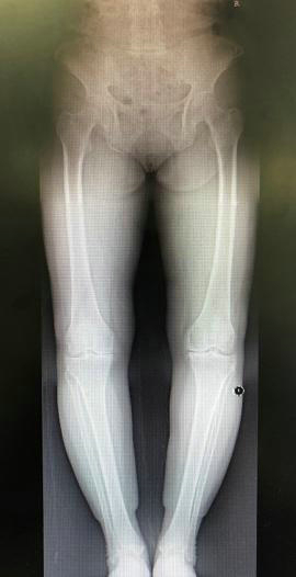 膝关节骨性关节炎的阶梯治疗