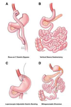 手术已成为2型糖尿病新的有效治疗方法