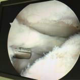 膝关节骨性关节炎的阶梯治疗