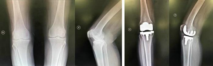 膝关节骨性关节炎的阶梯治疗