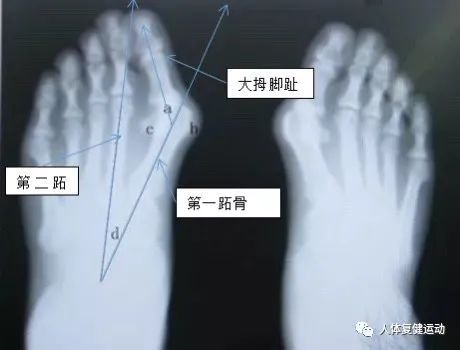 〖科普〗拇指外翻怎么办？如何纠正呢？