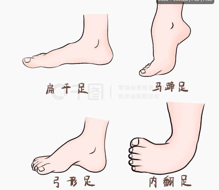 小儿马蹄足内翻最佳治疗时间