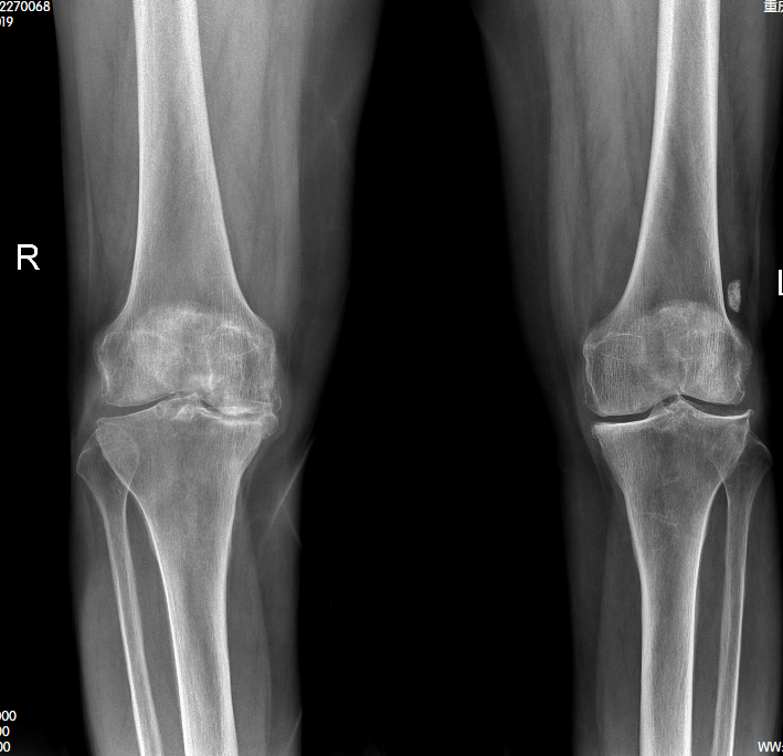 八旬婆婆双膝关节病痛十余年 长城骨科精准治疗助其重获行走自由