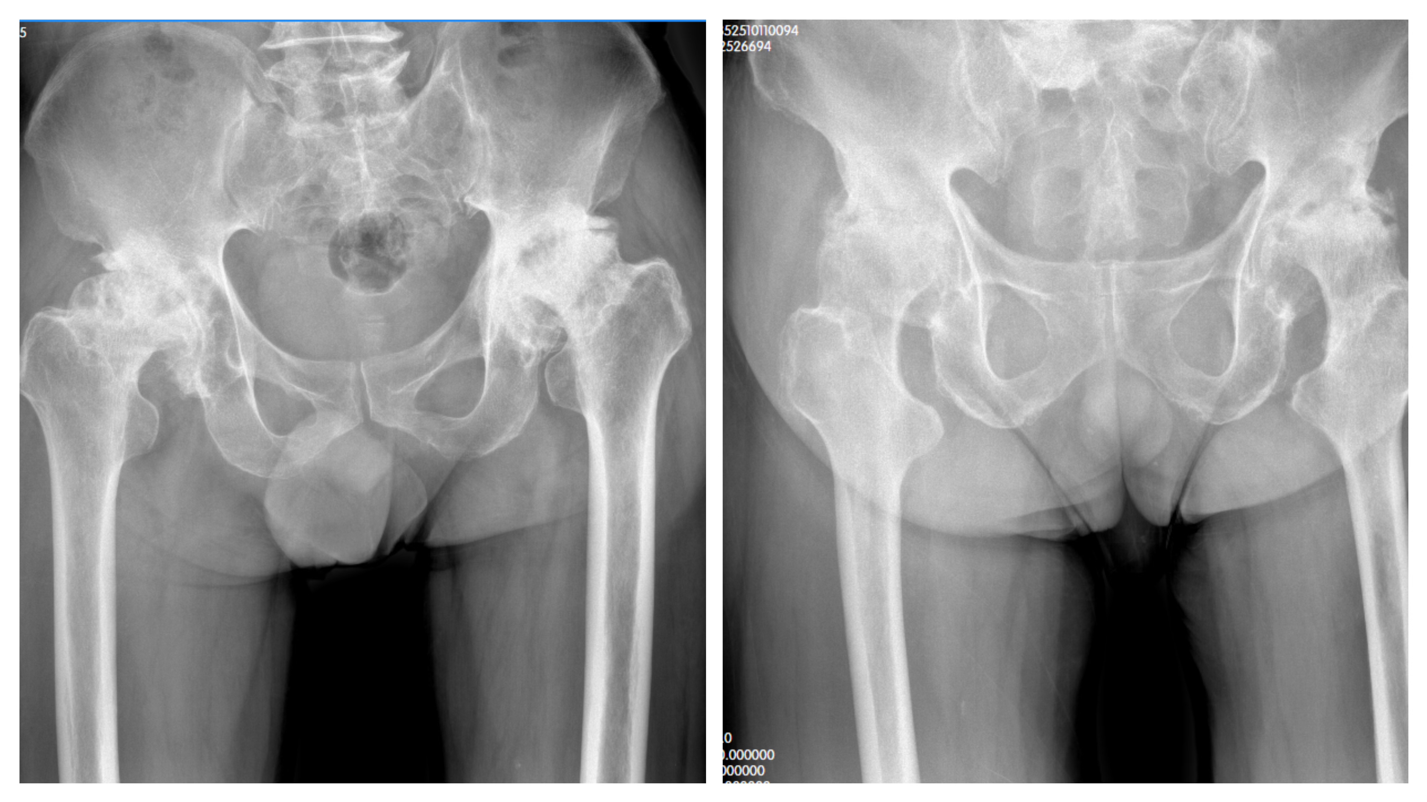 叔侄同患股骨头坏死 重庆长城骨科医院精准施治助康复