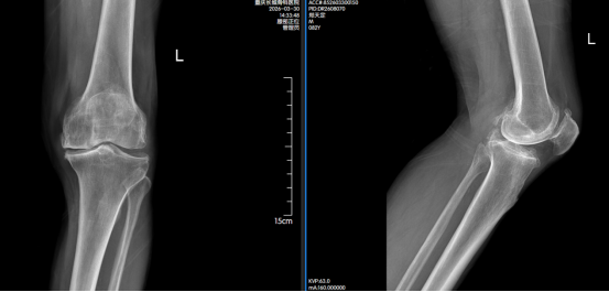 走路都成奢望，这位八旬老人为何在长城骨科重获自由？