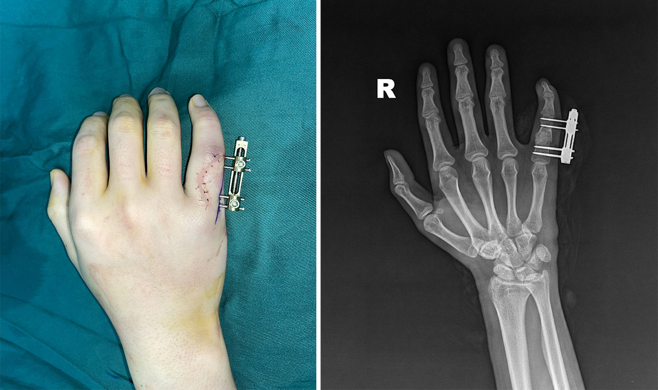 Mini外支架巧治小指病理性骨折，15岁少年跨省求医重获手功能