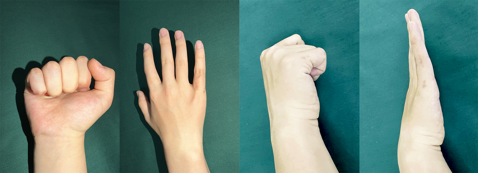 Mini外支架巧治小指病理性骨折，15岁少年跨省求医重获手功能