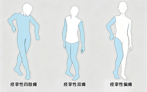姿势异常？从缓解痉挛到矫正肢体畸形 ——重庆长城骨科医院痉挛性脑瘫专病诊疗介绍