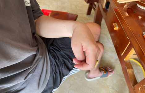 姿势异常？从缓解痉挛到矫正肢体畸形 ——重庆长城骨科医院痉挛性脑瘫专病诊疗介绍