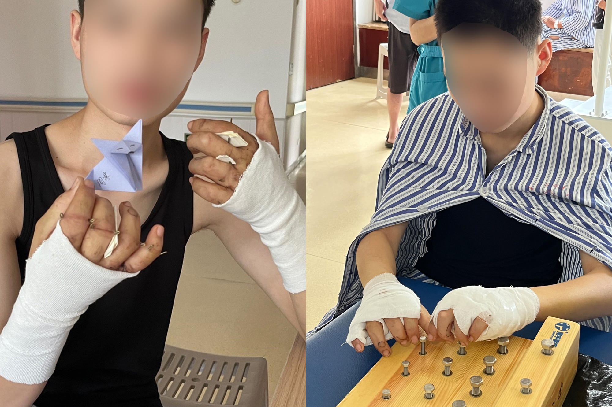 技术新突破!重庆长城骨科医院首例人工关节置换手术让完全离断的手指灵活动起来